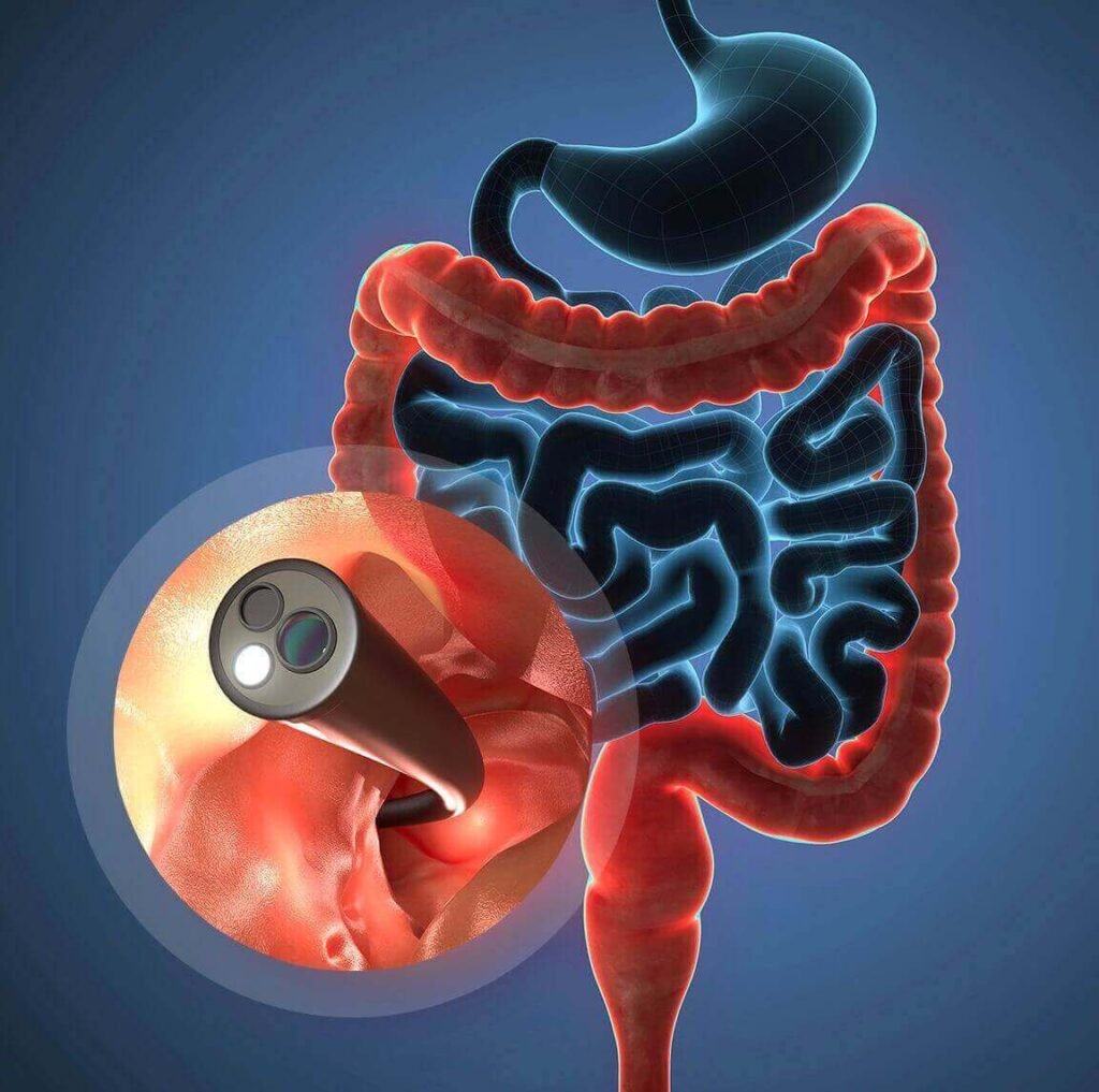 preparing-for-a-colonoscopy